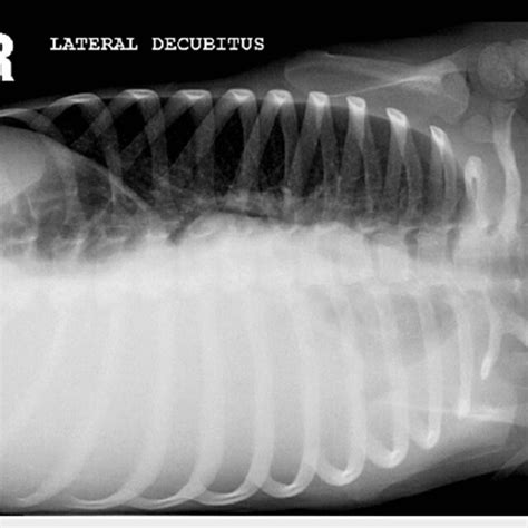 Plain Chest X Ray Right Lateral Decubitus View Showing A Large Free