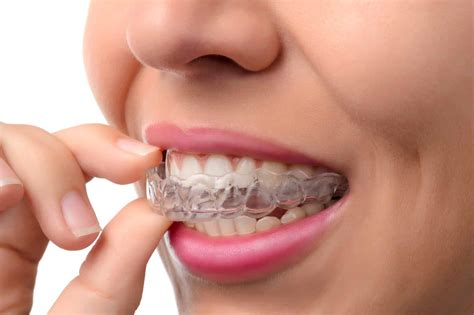 Tips For Living With Invisalign Clear Aligners Bailey Orthodontics
