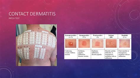 Dermatology Skin And Soft Tissue Infections Dermatitis Online