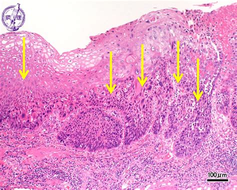 Esophagus Stomach Esophageal Carcinoma Squamous Cell Carcinoma Pathology Core Pictures