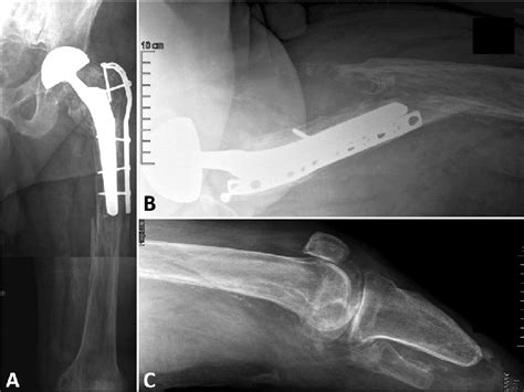 Standard Anteroposterior Radiograph Of The Left Hip And Femur A