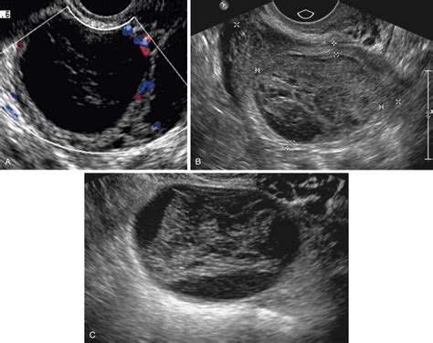 Benign Ovarian Masses Radiology Key