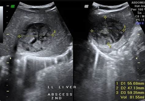 Liver Abscess With Hepato Pleural Fistula Sumers Radiology Blog