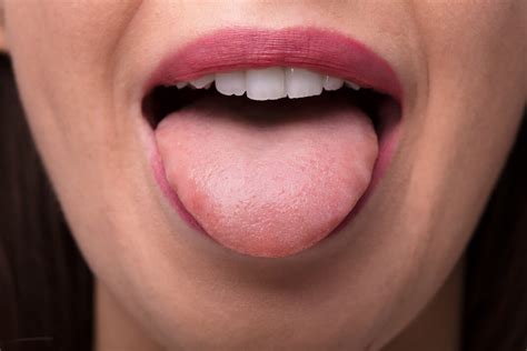 White Bump On Tongue Cancer