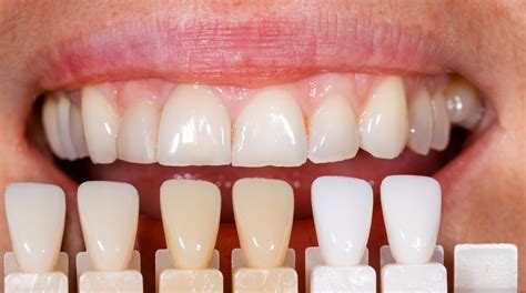 Once your teeth are good and white, limit yourself to using the whitening treatment once every month or two. Do you need veneers? - Traceybell