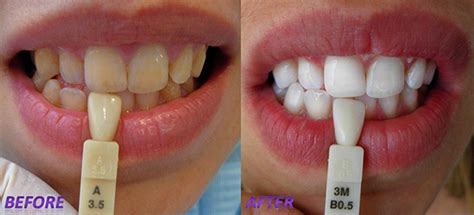 If you're wanting to know how much does it costs to get your teeth whitened, you'll find the answer in this video. Teeth Whitening-Is It Safe For The Teeth And Gums? How ...