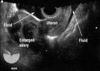 Pouch of douglas cystic lesion. Assisted conception. III-Problems with assisted conception ...