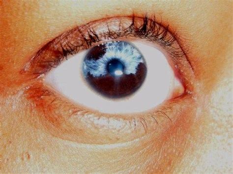 Partialsectoral Heterochromia — Part Of One Iris Is A Different Color