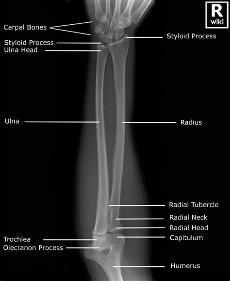 Forearm Radiographic Anatomy Wikiradiography