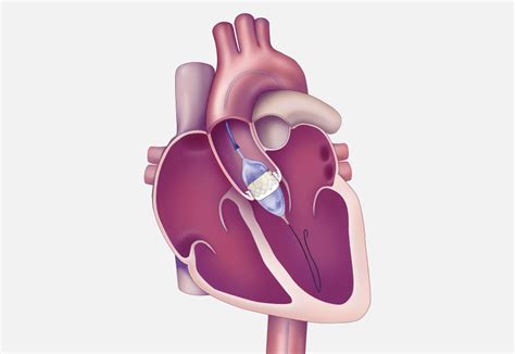 Transcatheter Heart Valves Edwards Lifesciences