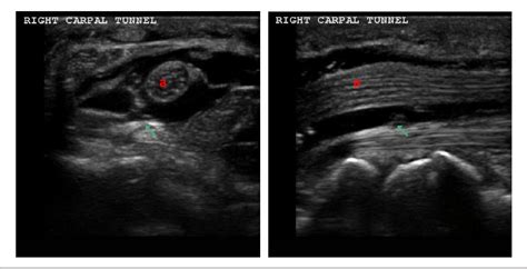 Carpal Tunnel Syndrome Ultrasound Guided Steroid Inje