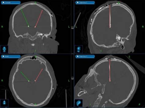 The Accuracy Of 3d Fluoroscopy Xt Vs Computed Tomography Ct
