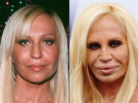 Celebrities Before And After Plastic Surgery Donatella Versace