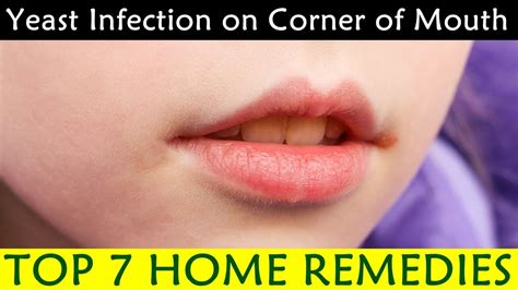 Yeast Infection On Corner Of Mouth Causes Symptoms