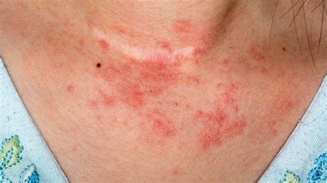 7 Types Of Eczema What Do Atopic Dermatitis And Other Eczema Types