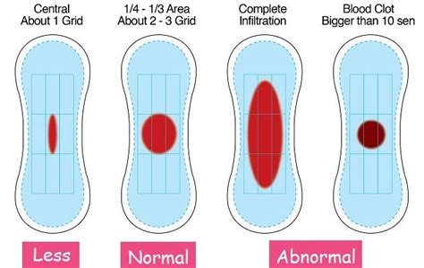 Are Blood Clots When On Period Normal Eiqlat