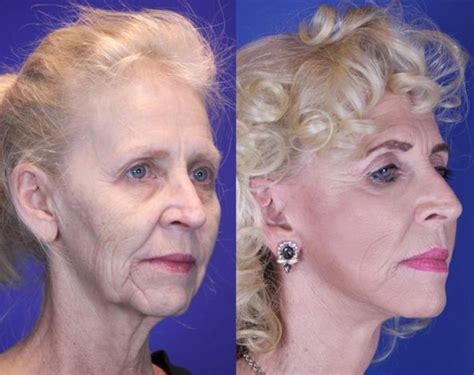 Facelift Reflection Lift Before And After Photo Gallery Brentwood Tn