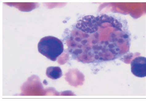 Figure From A Rare Cause Of Acquired Immune Deficiency Syndrome