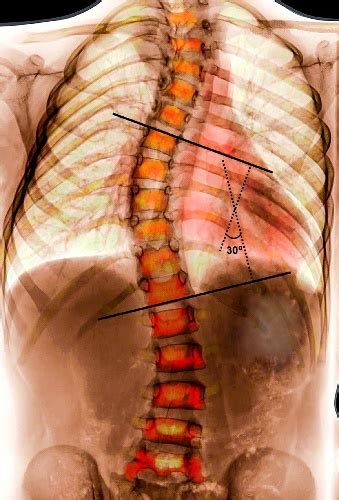 Measuring stream stage—obtaining a continuous record of stage—the height of the water surface at a location along a stream or river 2. How is Scoliosis Measured?