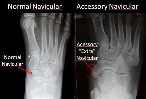 Accessory Navicular Bone Os Naviculare Footeducation Accessory