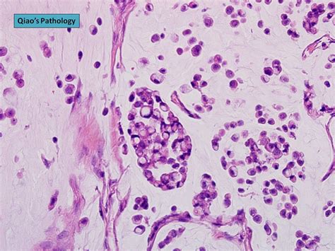 Qiaos Pathology Invasive Lobular Carcinoma With Extracellular Mucin
