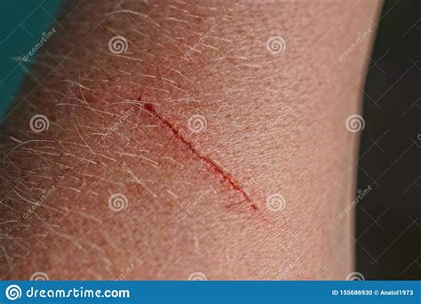 Red Long Cut Scratch The Skin Of The Hand Stock Photo Image Of Bloody