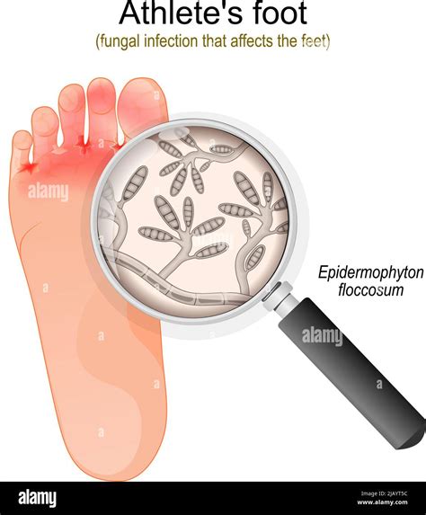 Athletes Foot Fungal Infection That Affects The Feet Close Up Of
