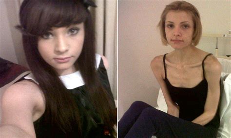 Anorexic Sian Clarke 19 Is Passed Between Five Hospitals After Her Weight Fell To Less Than