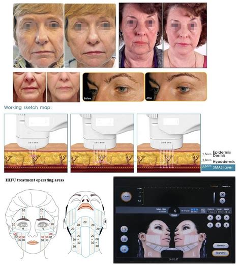 HIFU High Intensity Focused Ultrasound Facial Skin Rejuvenation Body Slimming