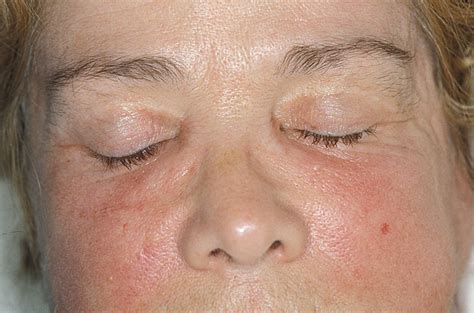 Adult Onset Stills Disease Revealed By Facial Edema Journal Of The