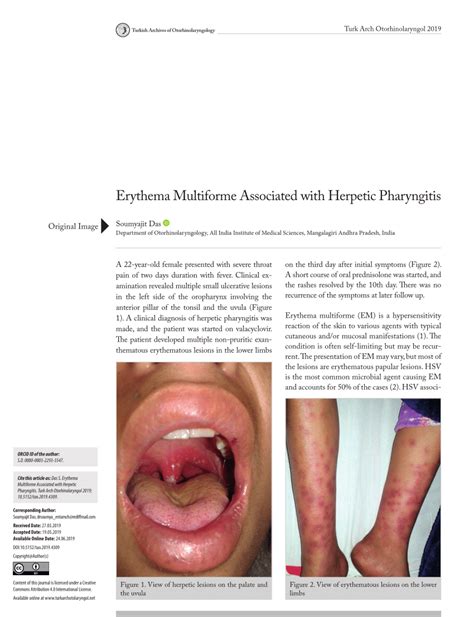 Erythema Multiforme Lips Herpes