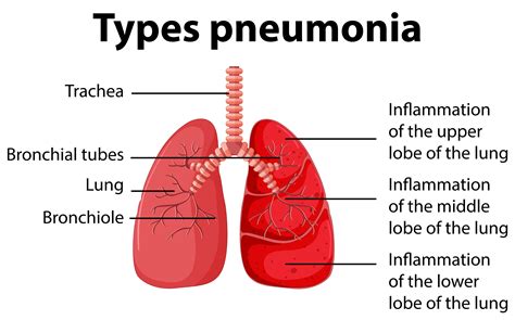 Diagram Showing Types Pneumonia 413792 Vector Art At Vecteezy