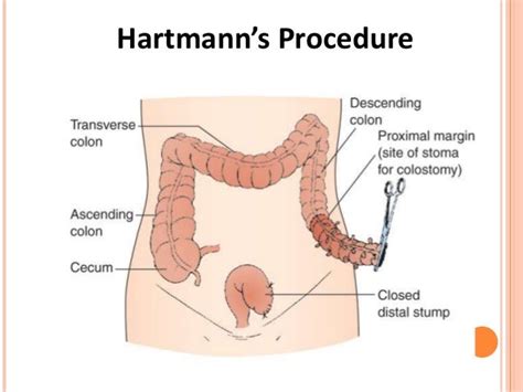 Stoma