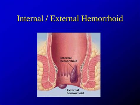 Thrombosed External Hemorrhoid Pictures Hemorrhoids Obgyn Key If