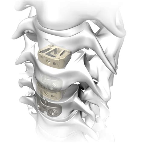 Cervical Interbody Fusion Cage Rebar Atlas Spine Anterior Peek My XXX