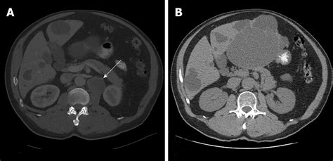 Metastatic Clear Cell Renal Cell Carcinoma In Isolated Retroperitoneal