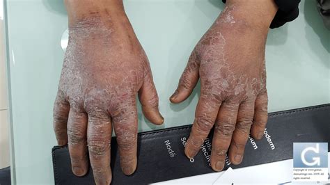 Global Dermatology Classifying Hand Eczema Is Not Solving Journal Club