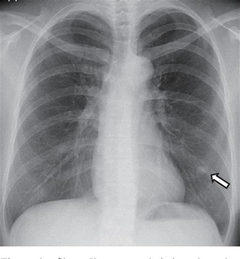 Figure 1 From A Case Of Pulmonary Benign Metastasizing Leiomyoma