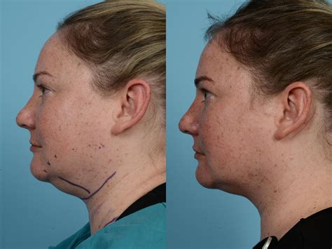 Precision TX Laser Before And After Pictures Case 583 Chicago IL