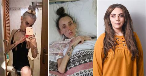 Anorexia Survivor Who Weighed Just 4st Shares Inspiring Recovery Story Metro News