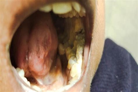 Picture Of Ulceroproliferative Growth Over Left Buccal Mucosa Without