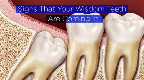 The Ways You Can Tell If Your Wisdom Teeth Are Coming In