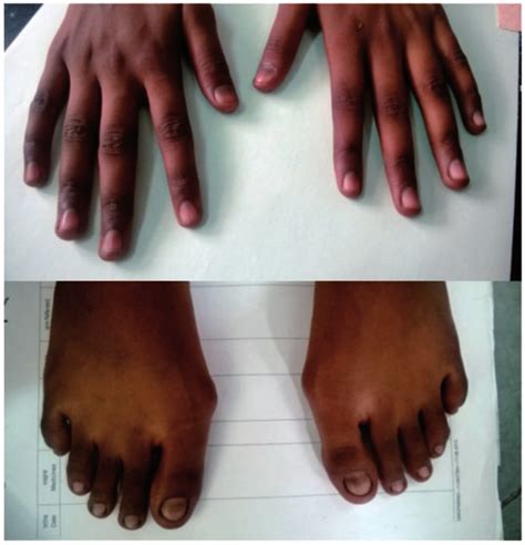 Knuckle Hyperpigmentation And Nail Hyperpigmentation In Both Hands And