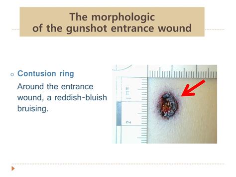 Ppt The Morphology Of Gunshot Entrance Wounds In Connection With The