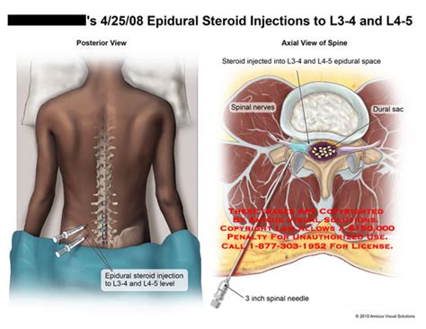 AMICUS Illustration Of Amicus Surgery Injection Epidural Steroid L3 L4