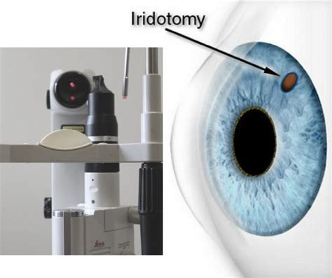 Iridotomia A Laser Para Prevenção Do Glaucoma Memorial Santa Luzia