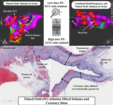 Focal Pulsed Field Ablation For Pulmonary Vein Isolation And Linear