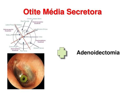 Ppt Otite Média Secretora Powerpoint Presentation Free Download Id