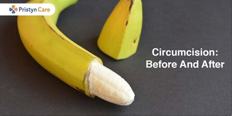 Circumcision Before And After