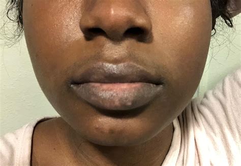 Skin Concerns Severe Hyperpigmentation And Patchy Dark Discoloration